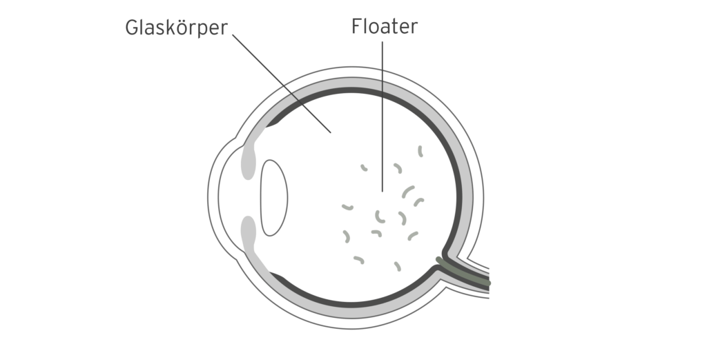 Erklärgrafik: Glaskörpertrübungen - Floater