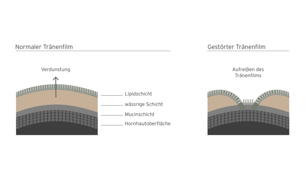 Erklärgrafik: Trockene Augen