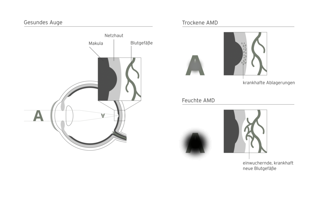 Erklärgrafik: AMD - Makuladegeneration