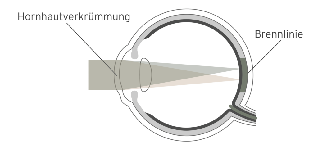 Erklär-Grafik Hornhautverkrümmung